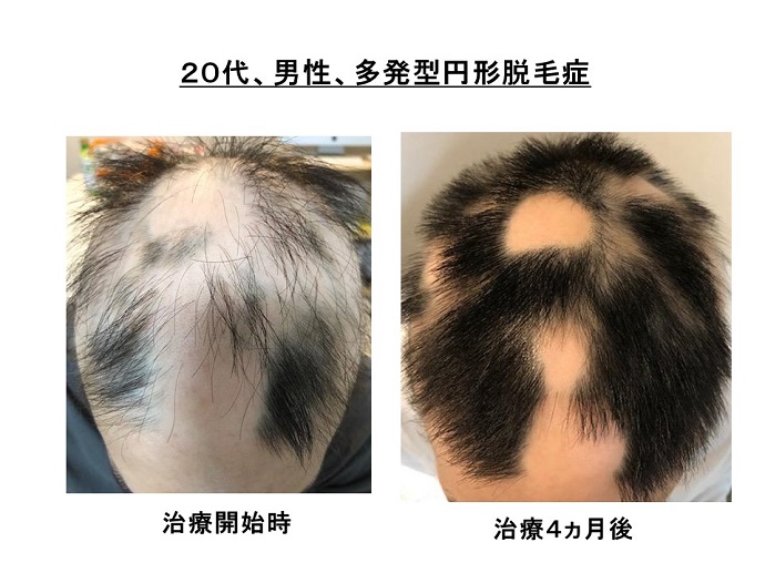 円形脱毛症　病院